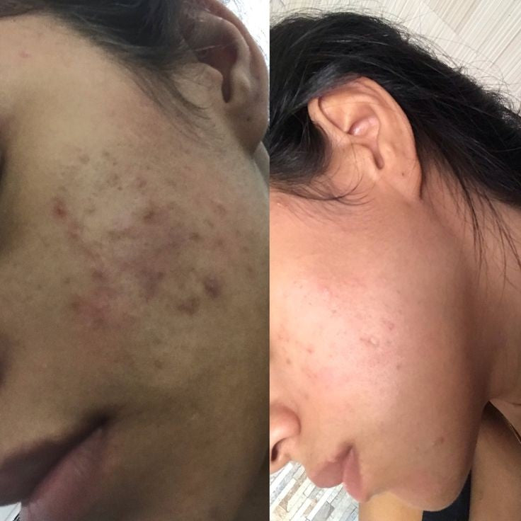 Some by mi Aknen darkspot gel