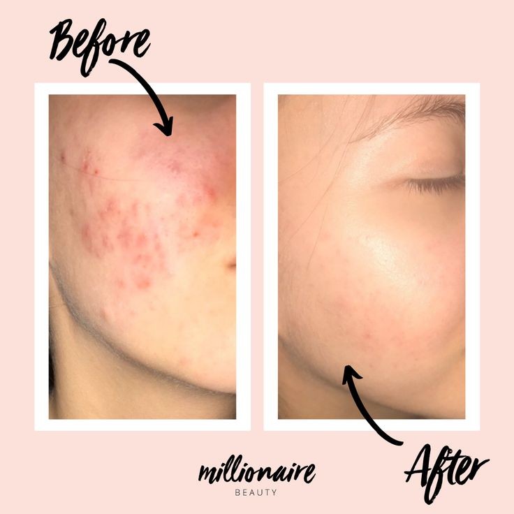 A'PIEU Glycolic acid cream