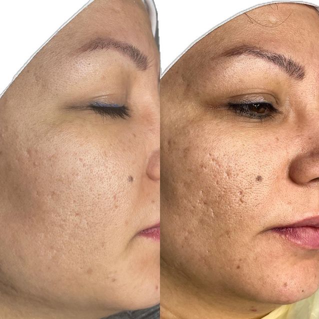 مجموعة لمعجزة لحبوب الظهر ولمؤخرة وندبات الوج وعلام الحب القوية والتصبغ