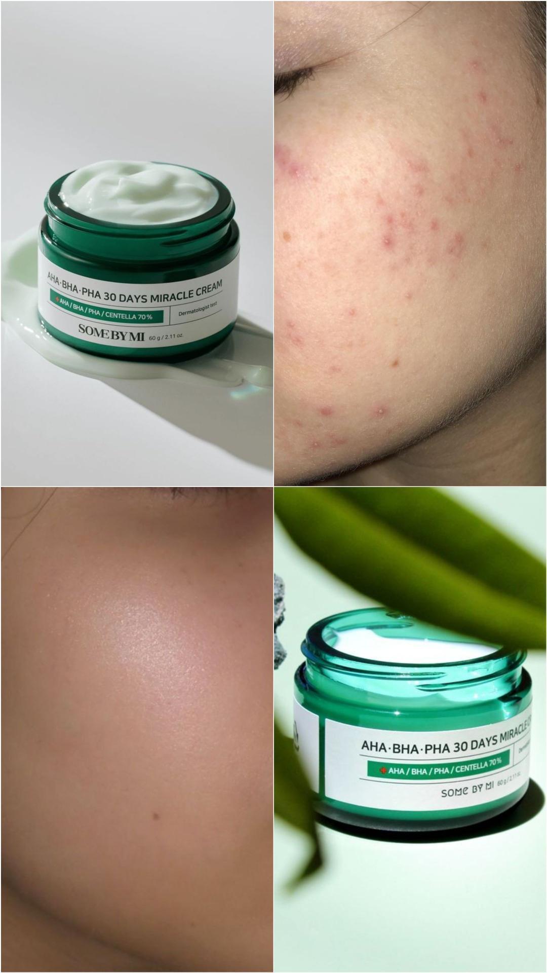 Some by mi Aknen Feuchtigkeit creme