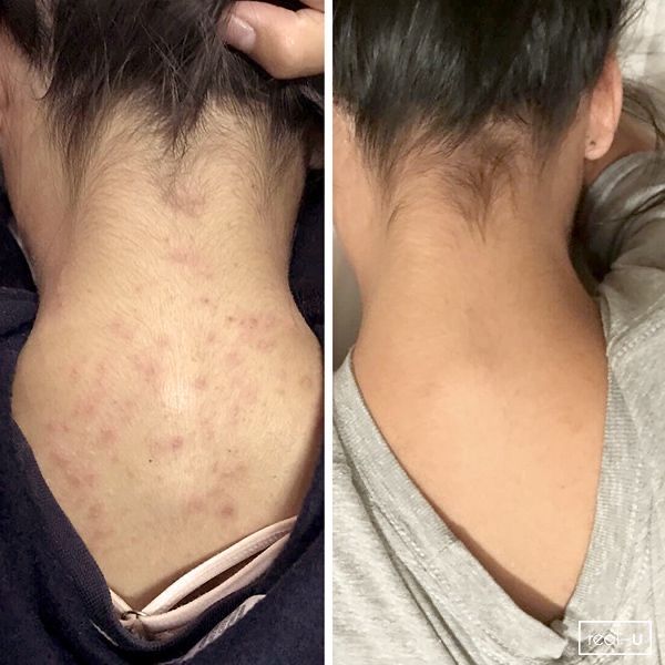 مجموعة لمعجزة لحبوب الظهر ولمؤخرة وندبات الوج وعلام الحب القوية والتصبغ