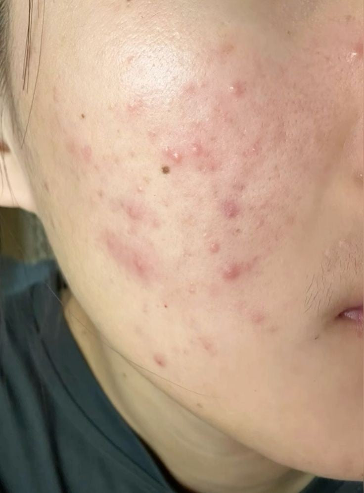 Some by mi Aknen Feuchtigkeit creme