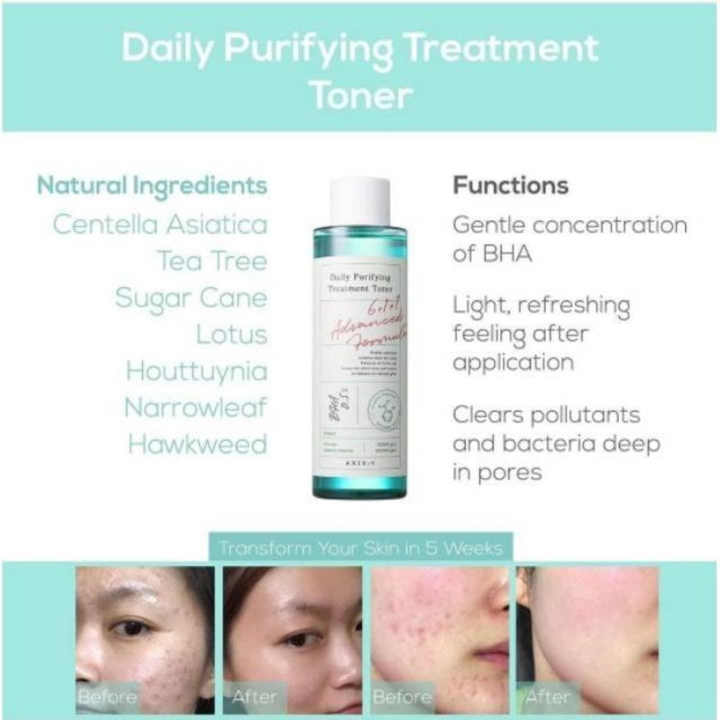 Axis-y Daily Purifying Treatment Toner 🍀💫
تونر البثور المركز والرؤوس السوداء والمسام الواسع